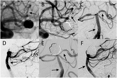 Bifurcated Aneurysm Location Predicts In-Stent Stenosis After Neuroform-EZ Stent-Assisted Coiling for Intracranial Aneurysm